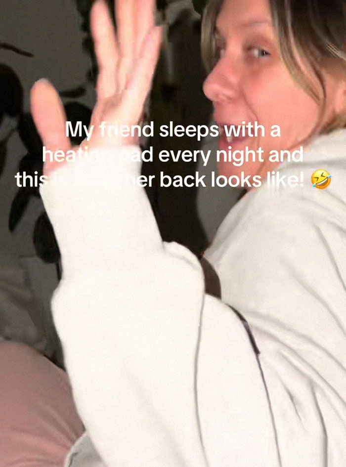 Woman’s Video Goes Viral After She Shows How Her Body Looks After Using A Heating Pad: “Toasted Skin Syndrome”