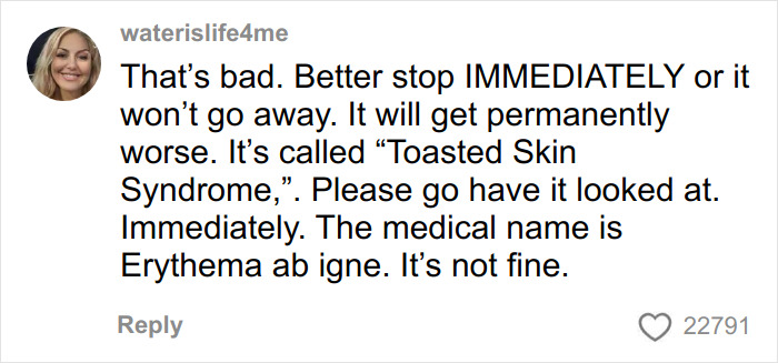 Woman’s Video Goes Viral After She Shows How Her Body Looks After Using A Heating Pad: “Toasted Skin Syndrome”