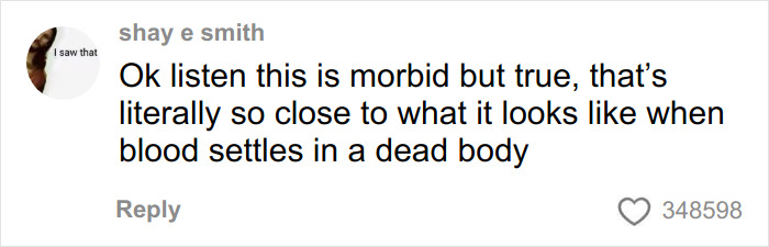 Woman’s Video Goes Viral After She Shows How Her Body Looks After Using A Heating Pad: “Toasted Skin Syndrome”