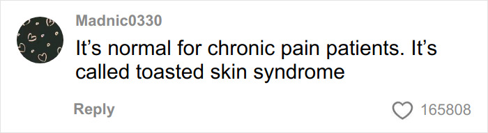 Woman’s Video Goes Viral After She Shows How Her Body Looks After Using A Heating Pad: “Toasted Skin Syndrome”