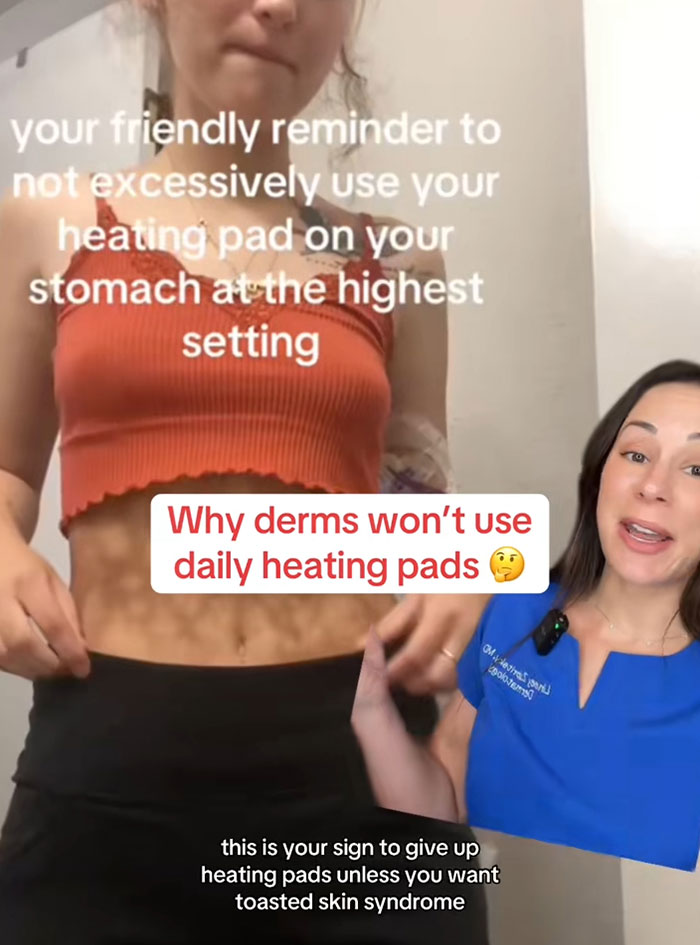 Woman’s Video Goes Viral After She Shows How Her Body Looks After Using A Heating Pad: “Toasted Skin Syndrome”