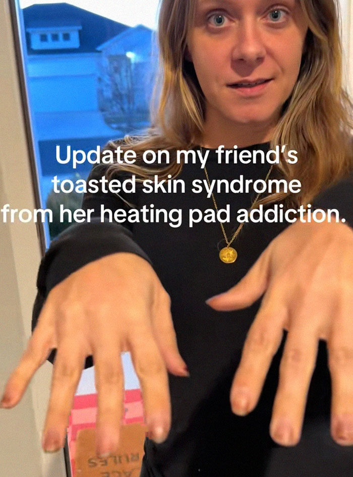 Woman’s Video Goes Viral After She Shows How Her Body Looks After Using A Heating Pad: “Toasted Skin Syndrome”