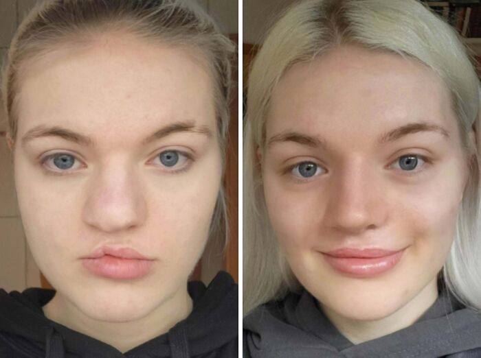 41 People Who Got Plastic Surgery And Now Look Like A Whole New Version Of Themselves 41 People Who Got Plastic Surgery And Now Look Like A Whole New Version Of Themselves