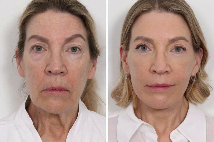 41 People Who Got Plastic Surgery And Now Look Like A Whole New Version Of Themselves 41 People Who Got Plastic Surgery And Now Look Like A Whole New Version Of Themselves