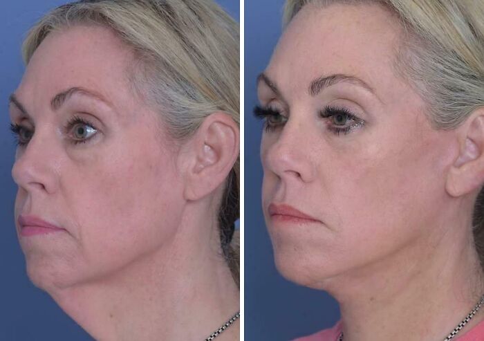 41 People Who Got Plastic Surgery And Now Look Like A Whole New Version Of Themselves 41 People Who Got Plastic Surgery And Now Look Like A Whole New Version Of Themselves