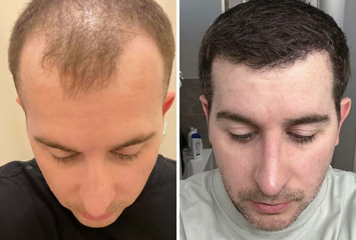 41 People Who Got Plastic Surgery And Now Look Like A Whole New Version Of Themselves 41 People Who Got Plastic Surgery And Now Look Like A Whole New Version Of Themselves