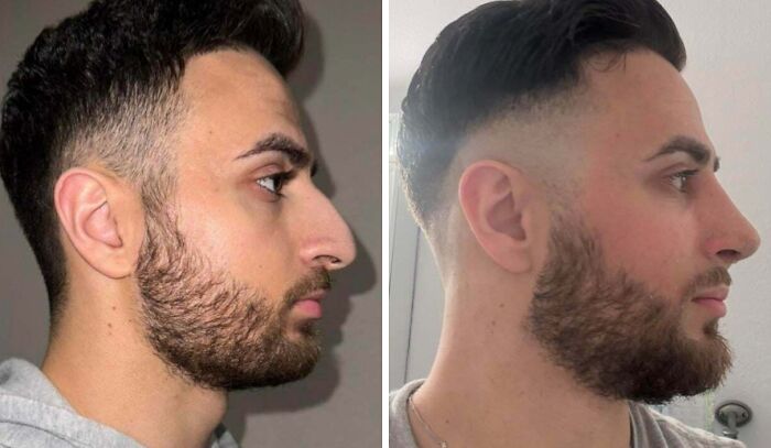 41 People Who Got Plastic Surgery And Now Look Like A Whole New Version Of Themselves 41 People Who Got Plastic Surgery And Now Look Like A Whole New Version Of Themselves