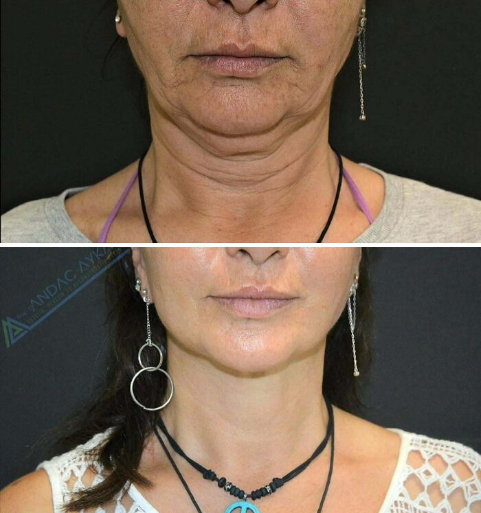 41 People Who Got Plastic Surgery And Now Look Like A Whole New Version Of Themselves 41 People Who Got Plastic Surgery And Now Look Like A Whole New Version Of Themselves