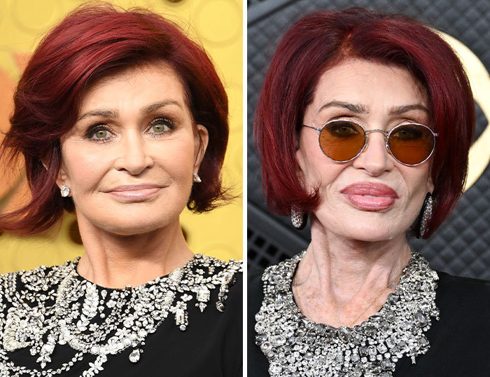 “How Is This Possible?”: Frenzy Over Botched Plastic Surgery And Weight Loss After The Grammys “How Is This Possible?”: Frenzy Over Botched Plastic Surgery And Weight Loss After The Grammys