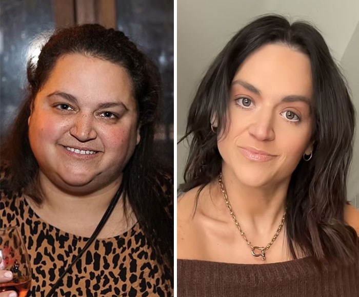 “I’ll Take Ozempic Face”: 77 People Share The Dramatic Facial Changes That Came With Their Ozempic Journey “I’ll Take Ozempic Face”: 77 People Share The Dramatic Facial Changes That Came With Their Ozempic Journey
