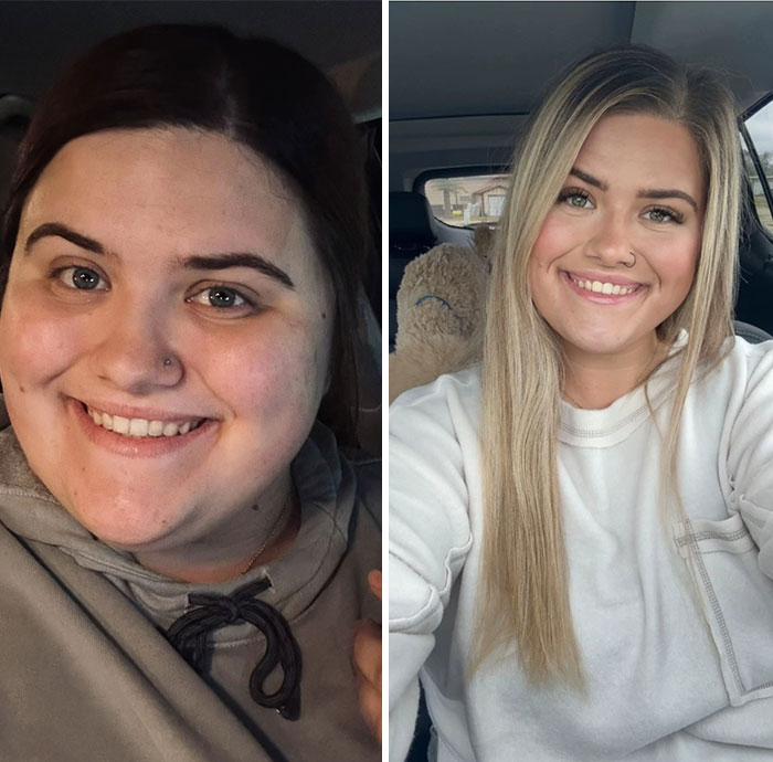 “I’ll Take Ozempic Face”: 77 People Share The Dramatic Facial Changes That Came With Their Ozempic Journey “I’ll Take Ozempic Face”: 77 People Share The Dramatic Facial Changes That Came With Their Ozempic Journey
