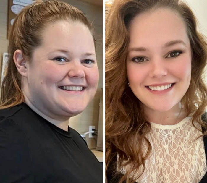 “I’ll Take Ozempic Face”: 77 People Share The Dramatic Facial Changes That Came With Their Ozempic Journey “I’ll Take Ozempic Face”: 77 People Share The Dramatic Facial Changes That Came With Their Ozempic Journey