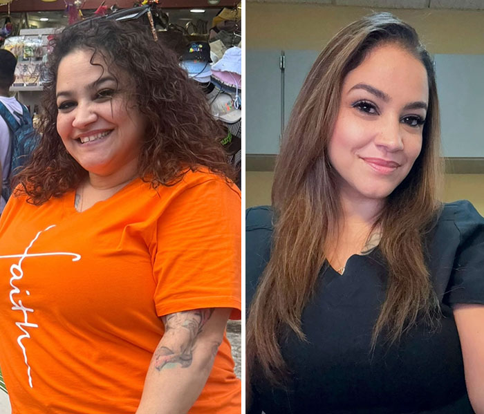 “I’ll Take Ozempic Face”: 77 People Share The Dramatic Facial Changes That Came With Their Ozempic Journey “I’ll Take Ozempic Face”: 77 People Share The Dramatic Facial Changes That Came With Their Ozempic Journey