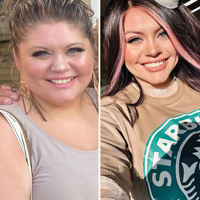 “I’ll Take Ozempic Face”: 77 People Share The Dramatic Facial Changes That Came With Their Ozempic Journey “I’ll Take Ozempic Face”: 77 People Share The Dramatic Facial Changes That Came With Their Ozempic Journey