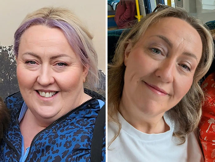 “I’ll Take Ozempic Face”: 77 People Share The Dramatic Facial Changes That Came With Their Ozempic Journey “I’ll Take Ozempic Face”: 77 People Share The Dramatic Facial Changes That Came With Their Ozempic Journey