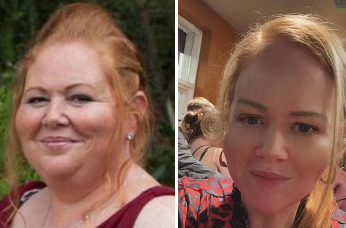 “I’ll Take Ozempic Face”: 77 People Share The Dramatic Facial Changes That Came With Their Ozempic Journey “I’ll Take Ozempic Face”: 77 People Share The Dramatic Facial Changes That Came With Their Ozempic Journey