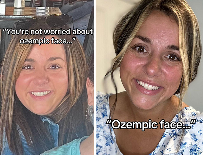 “I’ll Take Ozempic Face”: 77 People Share The Dramatic Facial Changes That Came With Their Ozempic Journey “I’ll Take Ozempic Face”: 77 People Share The Dramatic Facial Changes That Came With Their Ozempic Journey