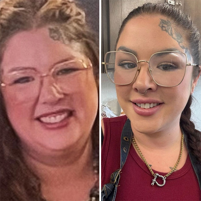 “I’ll Take Ozempic Face”: 77 People Share The Dramatic Facial Changes That Came With Their Ozempic Journey “I’ll Take Ozempic Face”: 77 People Share The Dramatic Facial Changes That Came With Their Ozempic Journey