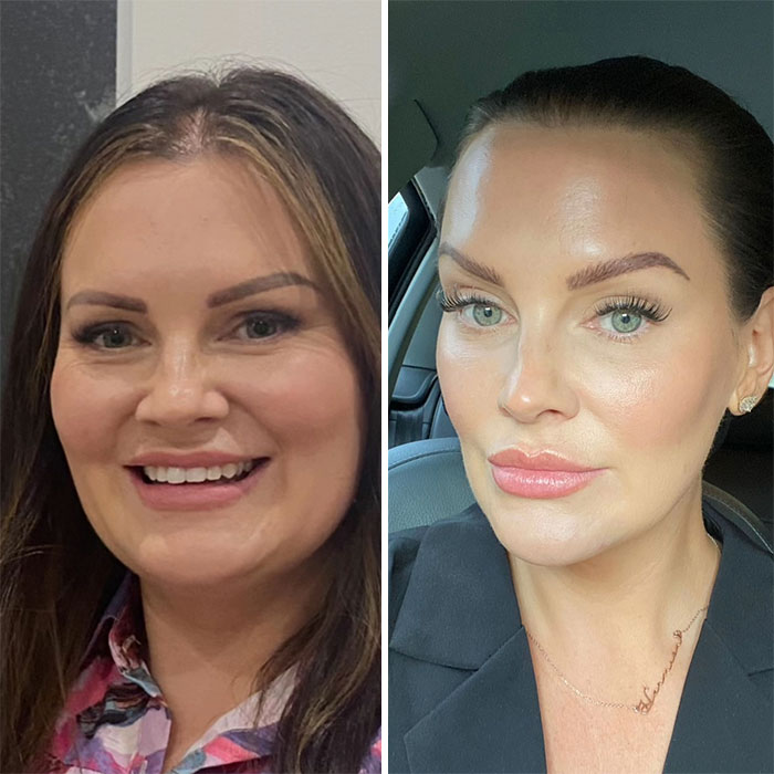 “I’ll Take Ozempic Face”: 77 People Share The Dramatic Facial Changes That Came With Their Ozempic Journey “I’ll Take Ozempic Face”: 77 People Share The Dramatic Facial Changes That Came With Their Ozempic Journey
