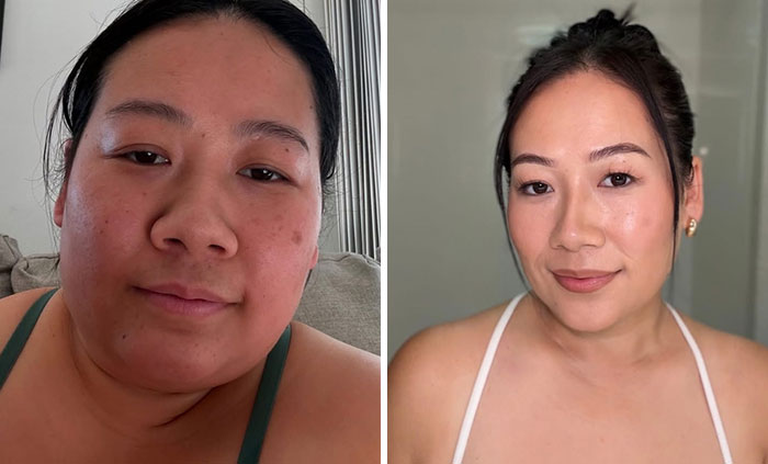 “I’ll Take Ozempic Face”: 77 People Share The Dramatic Facial Changes That Came With Their Ozempic Journey “I’ll Take Ozempic Face”: 77 People Share The Dramatic Facial Changes That Came With Their Ozempic Journey