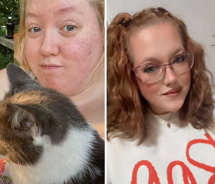 “I’ll Take Ozempic Face”: 77 People Share The Dramatic Facial Changes That Came With Their Ozempic Journey “I’ll Take Ozempic Face”: 77 People Share The Dramatic Facial Changes That Came With Their Ozempic Journey