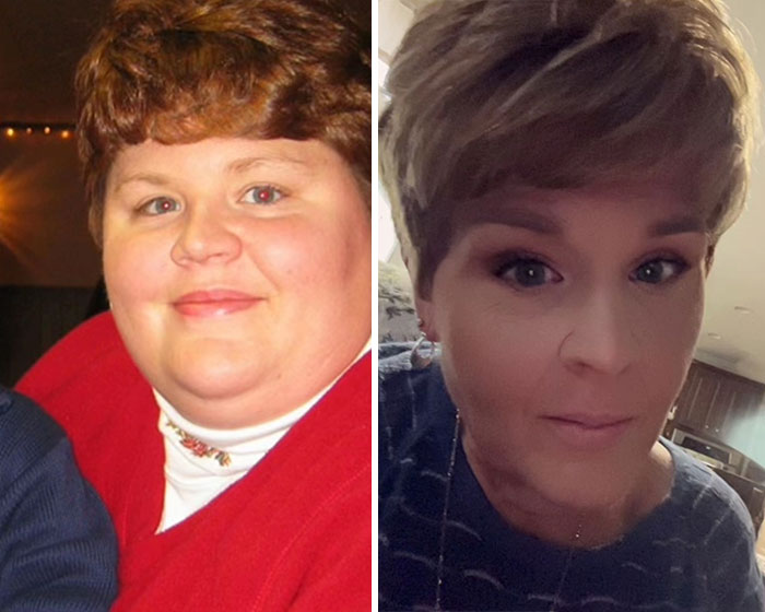 “I’ll Take Ozempic Face”: 77 People Share The Dramatic Facial Changes That Came With Their Ozempic Journey “I’ll Take Ozempic Face”: 77 People Share The Dramatic Facial Changes That Came With Their Ozempic Journey