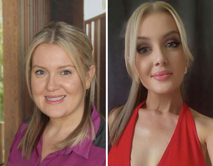 “I’ll Take Ozempic Face”: 77 People Share The Dramatic Facial Changes That Came With Their Ozempic Journey “I’ll Take Ozempic Face”: 77 People Share The Dramatic Facial Changes That Came With Their Ozempic Journey