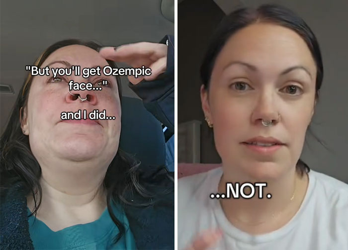 “I’ll Take Ozempic Face”: 77 People Share The Dramatic Facial Changes That Came With Their Ozempic Journey “I’ll Take Ozempic Face”: 77 People Share The Dramatic Facial Changes That Came With Their Ozempic Journey