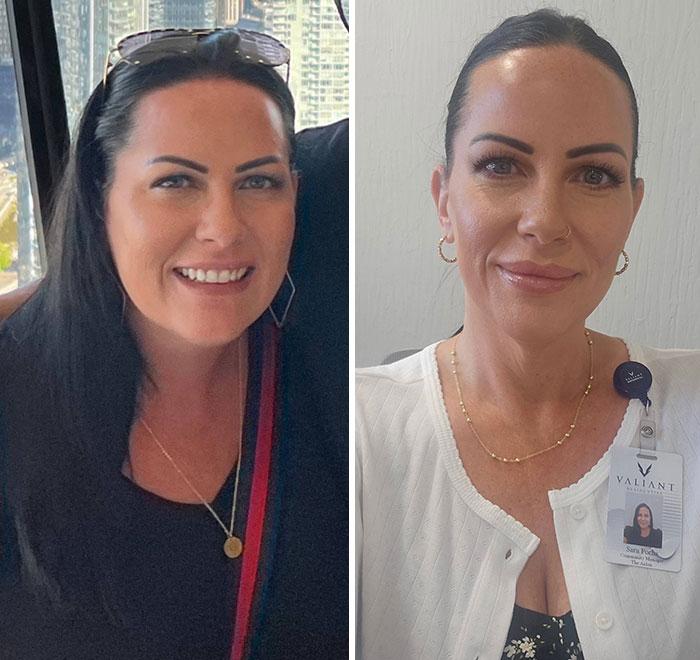 “I’ll Take Ozempic Face”: 77 People Share The Dramatic Facial Changes That Came With Their Ozempic Journey “I’ll Take Ozempic Face”: 77 People Share The Dramatic Facial Changes That Came With Their Ozempic Journey
