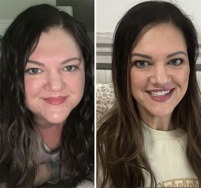 “I’ll Take Ozempic Face”: 77 People Share The Dramatic Facial Changes That Came With Their Ozempic Journey “I’ll Take Ozempic Face”: 77 People Share The Dramatic Facial Changes That Came With Their Ozempic Journey