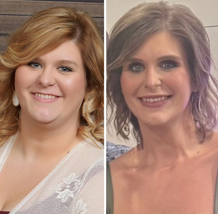 “I’ll Take Ozempic Face”: 77 People Share The Dramatic Facial Changes That Came With Their Ozempic Journey “I’ll Take Ozempic Face”: 77 People Share The Dramatic Facial Changes That Came With Their Ozempic Journey