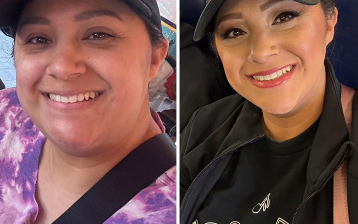 “I’ll Take Ozempic Face”: 77 People Share The Dramatic Facial Changes That Came With Their Ozempic Journey “I’ll Take Ozempic Face”: 77 People Share The Dramatic Facial Changes That Came With Their Ozempic Journey