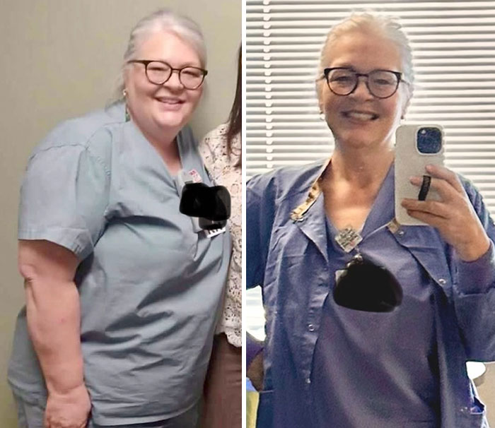 “I’ll Take Ozempic Face”: 77 People Share The Dramatic Facial Changes That Came With Their Ozempic Journey “I’ll Take Ozempic Face”: 77 People Share The Dramatic Facial Changes That Came With Their Ozempic Journey