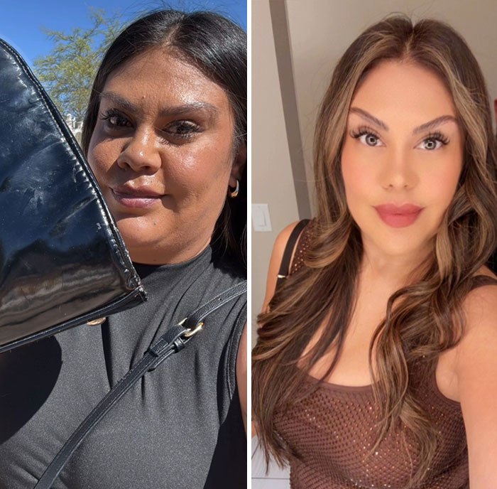 “I’ll Take Ozempic Face”: 77 People Share The Dramatic Facial Changes That Came With Their Ozempic Journey “I’ll Take Ozempic Face”: 77 People Share The Dramatic Facial Changes That Came With Their Ozempic Journey