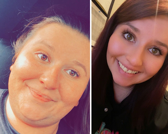 “I’ll Take Ozempic Face”: 77 People Share The Dramatic Facial Changes That Came With Their Ozempic Journey “I’ll Take Ozempic Face”: 77 People Share The Dramatic Facial Changes That Came With Their Ozempic Journey