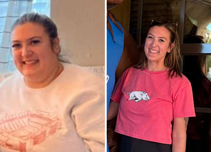 “I’ll Take Ozempic Face”: 77 People Share The Dramatic Facial Changes That Came With Their Ozempic Journey “I’ll Take Ozempic Face”: 77 People Share The Dramatic Facial Changes That Came With Their Ozempic Journey