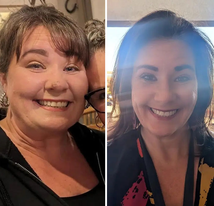 “I’ll Take Ozempic Face”: 77 People Share The Dramatic Facial Changes That Came With Their Ozempic Journey “I’ll Take Ozempic Face”: 77 People Share The Dramatic Facial Changes That Came With Their Ozempic Journey