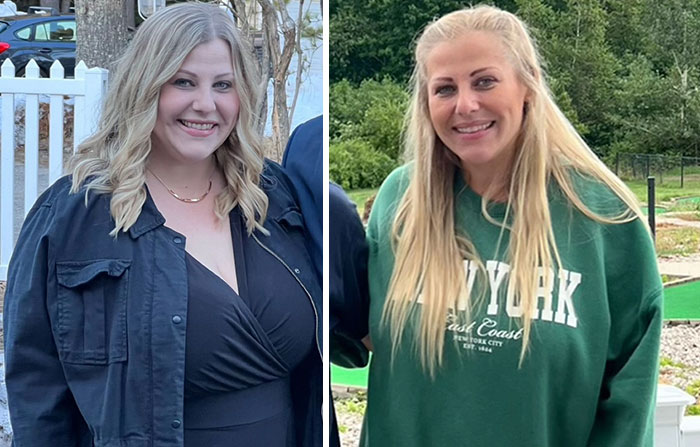 “I’ll Take Ozempic Face”: 77 People Share The Dramatic Facial Changes That Came With Their Ozempic Journey “I’ll Take Ozempic Face”: 77 People Share The Dramatic Facial Changes That Came With Their Ozempic Journey