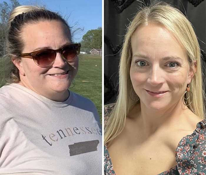 “I’ll Take Ozempic Face”: 77 People Share The Dramatic Facial Changes That Came With Their Ozempic Journey “I’ll Take Ozempic Face”: 77 People Share The Dramatic Facial Changes That Came With Their Ozempic Journey