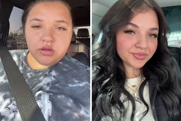 “I’ll Take Ozempic Face”: 77 People Share The Dramatic Facial Changes That Came With Their Ozempic Journey “I’ll Take Ozempic Face”: 77 People Share The Dramatic Facial Changes That Came With Their Ozempic Journey