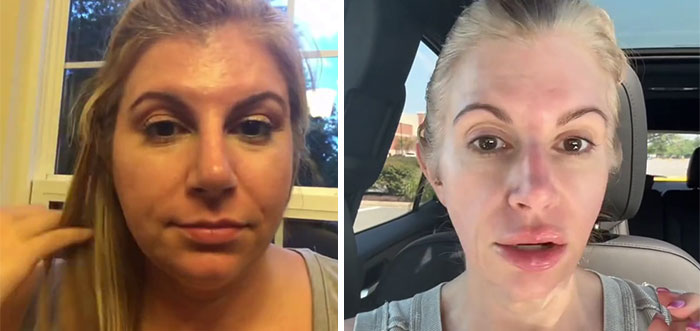 “I’ll Take Ozempic Face”: 77 People Share The Dramatic Facial Changes That Came With Their Ozempic Journey “I’ll Take Ozempic Face”: 77 People Share The Dramatic Facial Changes That Came With Their Ozempic Journey