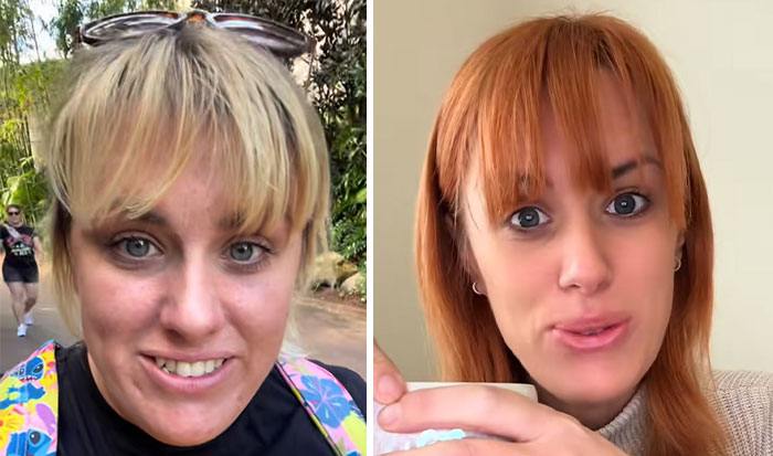 “I’ll Take Ozempic Face”: 77 People Share The Dramatic Facial Changes That Came With Their Ozempic Journey “I’ll Take Ozempic Face”: 77 People Share The Dramatic Facial Changes That Came With Their Ozempic Journey