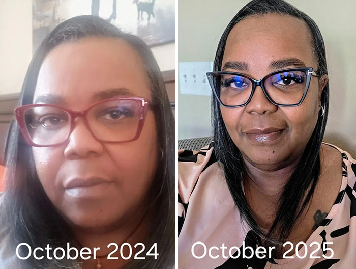 “I’ll Take Ozempic Face”: 77 People Share The Dramatic Facial Changes That Came With Their Ozempic Journey “I’ll Take Ozempic Face”: 77 People Share The Dramatic Facial Changes That Came With Their Ozempic Journey