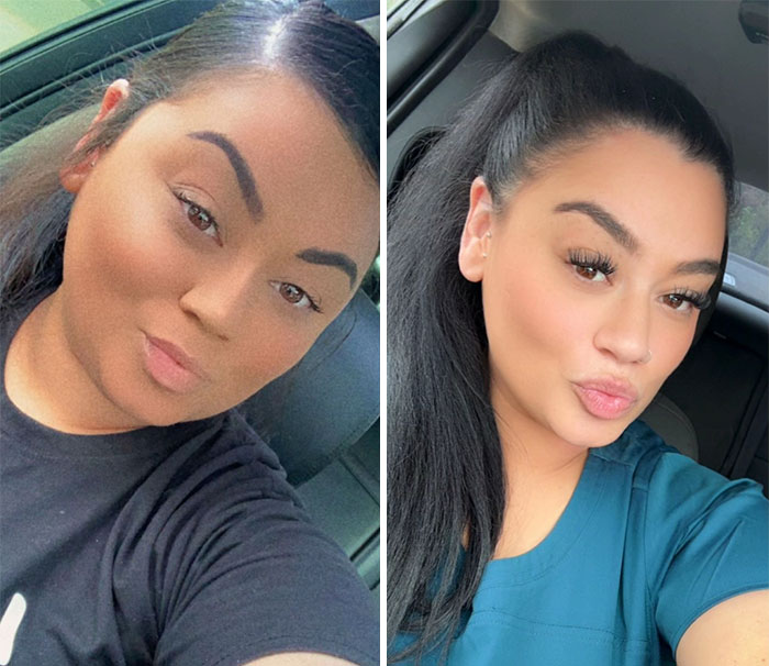 “I’ll Take Ozempic Face”: 77 People Share The Dramatic Facial Changes That Came With Their Ozempic Journey “I’ll Take Ozempic Face”: 77 People Share The Dramatic Facial Changes That Came With Their Ozempic Journey