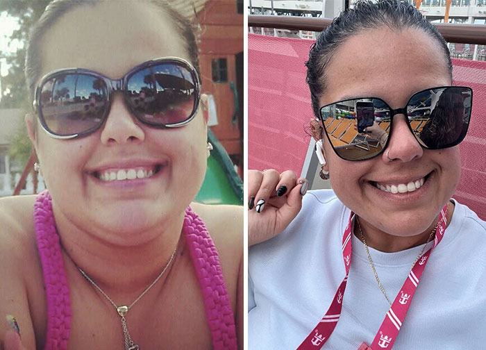 “I’ll Take Ozempic Face”: 77 People Share The Dramatic Facial Changes That Came With Their Ozempic Journey “I’ll Take Ozempic Face”: 77 People Share The Dramatic Facial Changes That Came With Their Ozempic Journey