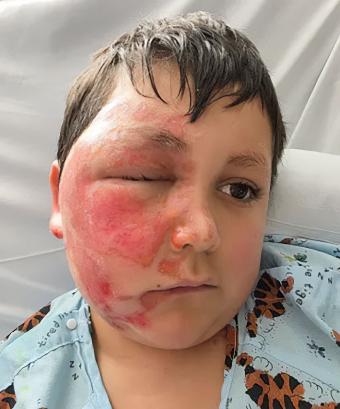 9-Year-Old Suffers Severe Facial Burns After Dangerous TikTok Trend Goes Horribly Wrong