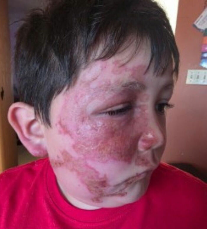 9-Year-Old Suffers Severe Facial Burns After Dangerous TikTok Trend Goes Horribly Wrong