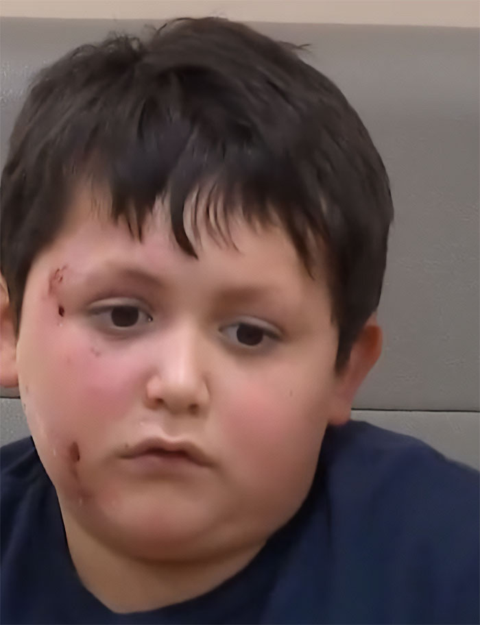 9-Year-Old Suffers Severe Facial Burns After Dangerous TikTok Trend Goes Horribly Wrong