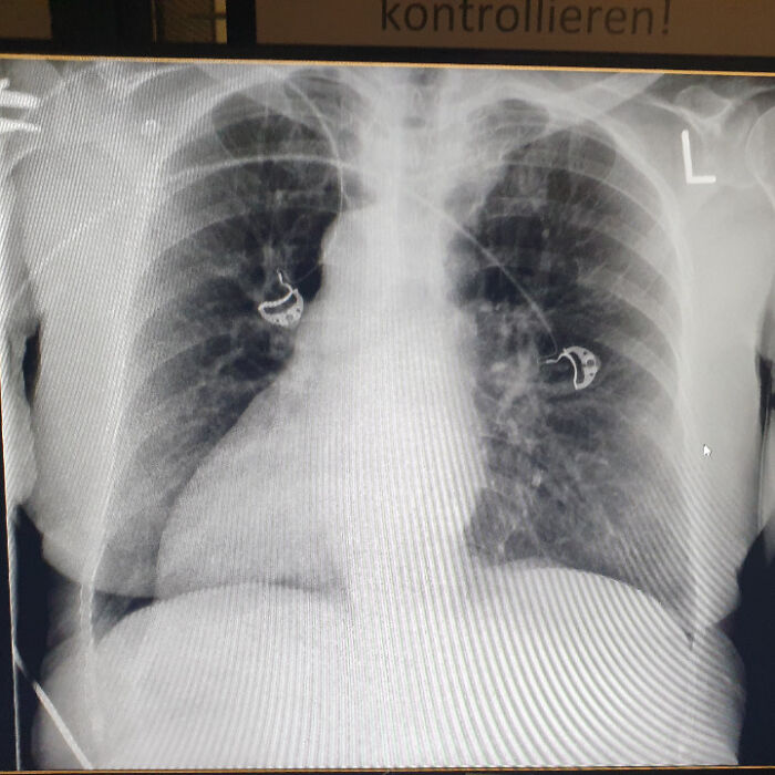 44 Autopsy Findings That Were So Strange, Even Doctors Were Speechless 44 Autopsy Findings That Were So Strange, Even Doctors Were Speechless