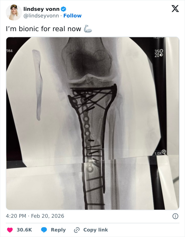 Following Fifth Surgery On Broken Leg, Lindsey Vonn Speaks Out And Makes Heartbreaking Admission
